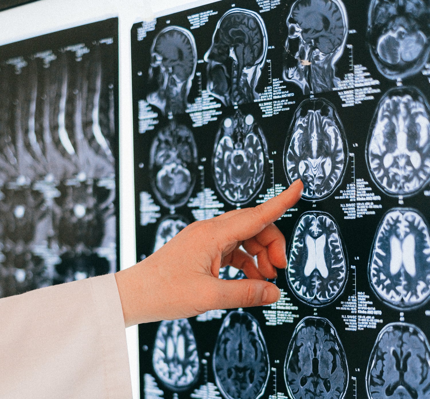 The Silent Storm: Unveiling the Relationship Between Hypertension and Hemorrhage